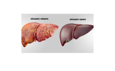 El hígado graso afecta al 23% de los chilenos